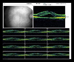 RADIAL LINE OD